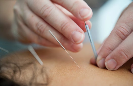 ACUPUNCTURE-katherine-hanlon-QgcdtM9rA5s-unsplash-min